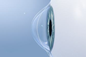 Современное лечение кератоконуса в Ессентуках