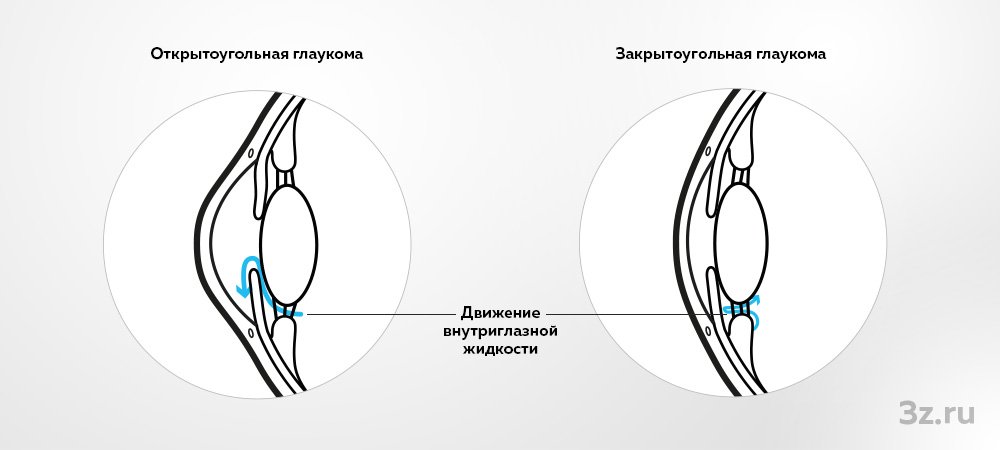 Что такое глаукома? Причины, симптомы, диагностика и лечение глаукомы | Блог | GlazСo