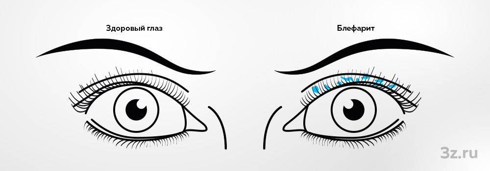 Блефарит - Заболевания глаз - Справочник MSD Профессиональная версия