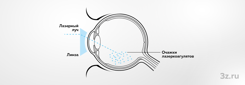 Лазерная коагуляция после операции. Периферическая лазеркоагуляция сетчатки глаза. Периферическая профилактическая лазерная коагуляция сетчатки. Припаивание сетчатки глаза лазером. Лазерной коагуляции сосудов сетчатки.