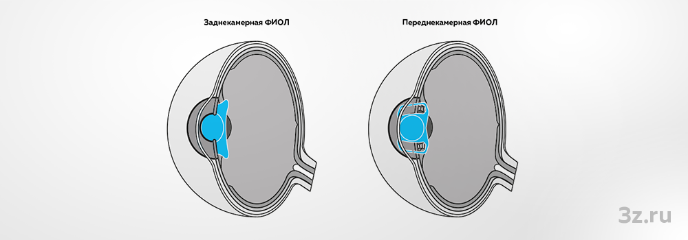 Расположение заднекамерной и переднекамерной ФИОЛ в глазу