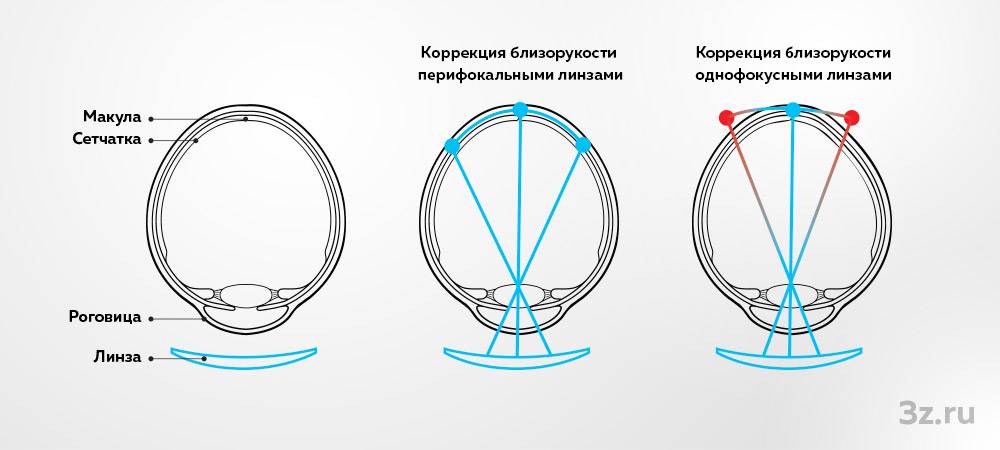 Перифокальные очковые линзы: защита зрения и комфорт